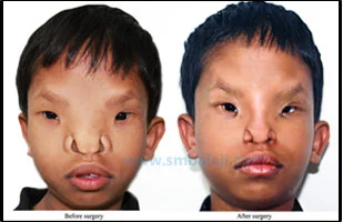 Severe orbital hypertelorism, before and after surgery. Image credit: smbalaji.com .
