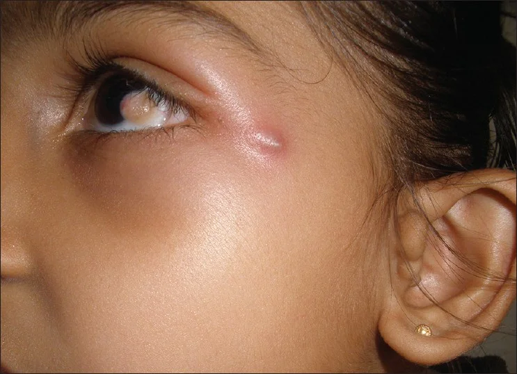 Goldenhar syndrome with limbal dermoid and preauricular skin tags. Image credit: Gaurkar SP, Gupta KD, Parmar KS, Shah BJ. Goldenhar syndrome: A report of 3 cases. Indian Journal of Dermatology. 2013:58(3);244. Available online.