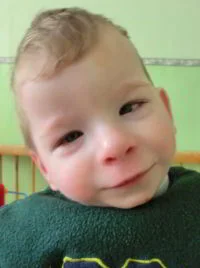 Fetal alcohol syndrome. Image credit: kidstoadopt.org .