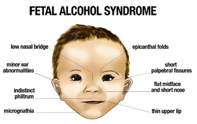 Maxillary Hypoplasia Fetal Alcohol