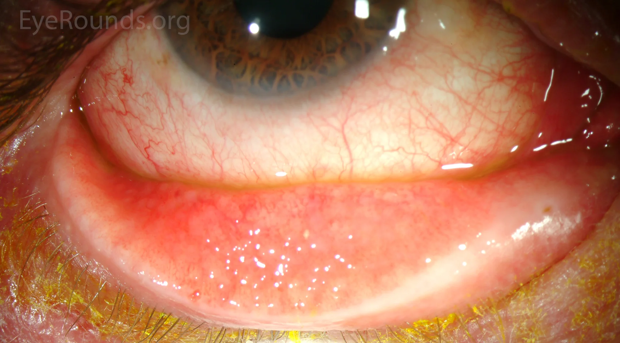 Follicular conjunctivitis. Image credit: University of Iowa, EyeRounds.org .