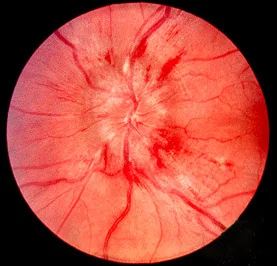 Papilledema. No one wants to see this on a Friday afternoon. Image credit: Wikipedia