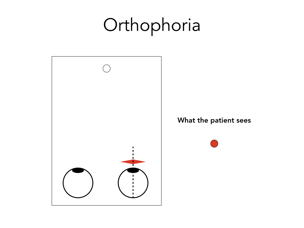 In a patient with normal alignment (orthophoria), the patient will report seeing only one circle/light (red or white, depending on which eye is dominant).