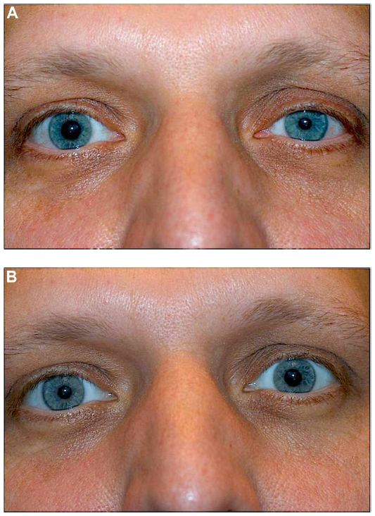 Horner Syndrome: Pharmacologic Diagnosis — Ophthalmology Review