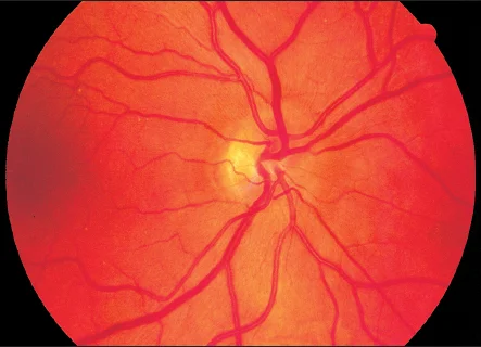 Hyperopic optic nerve (Entokey).jpg