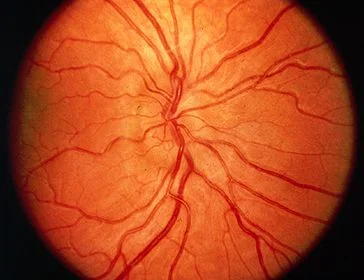 Hyperopic optic nerve (Golnik, UpToDate).jpg