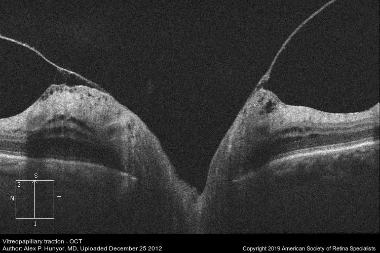 Vitreopapillary traction (ASRS-RIB-Image-2916).jpg