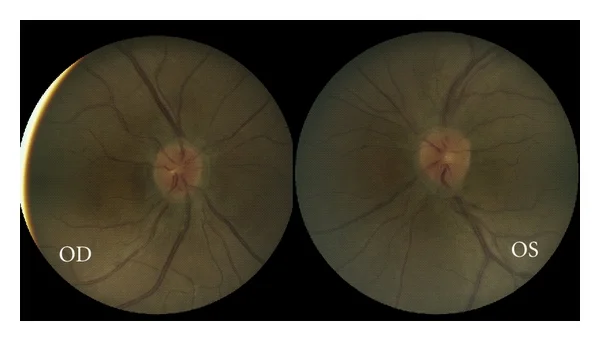 Vitreopapillary traction 4 - color fundus photos (Houle and Miller).jpg