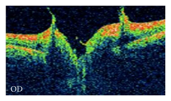 Vitreopapillary traction 5 - OCT OD (Houle and Miller).jpg