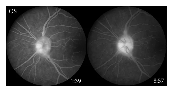 Vitreopapillary traction 8 - FA OS (Houle and Miller).jpg