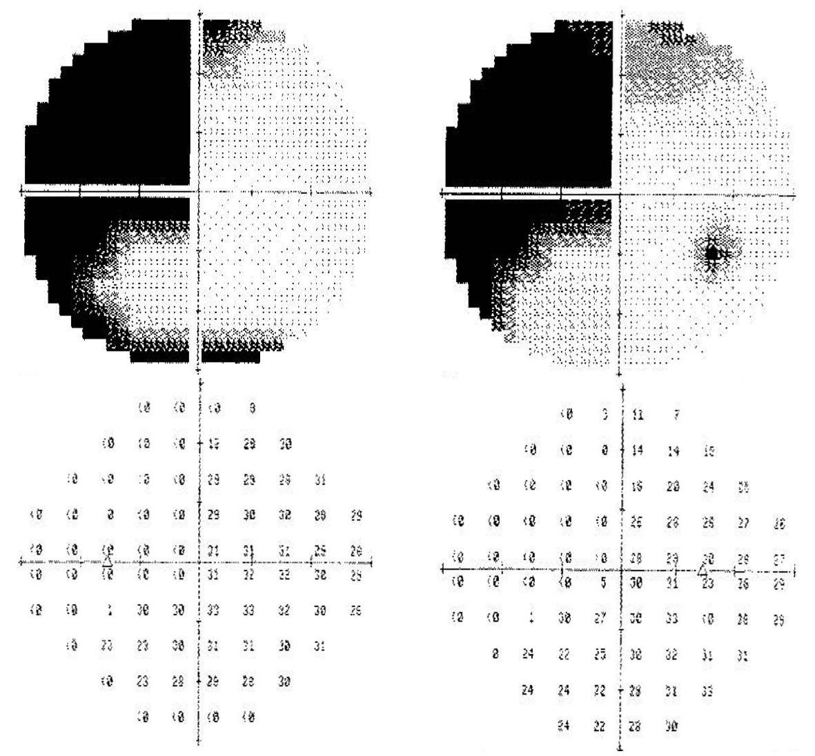 Visual Field Defects In Vascular Lesions vs. Tumors — Ophthalmology Review
