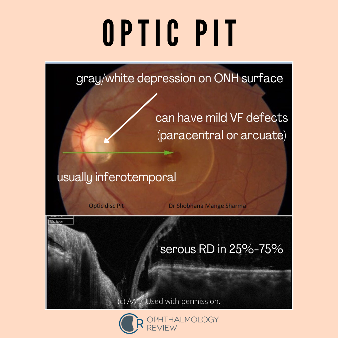 Optic Disc Glaucoma Treatment At Harry Boykin Blog Optic Disc Glaucoma Treatment At Harry Boykin Blog