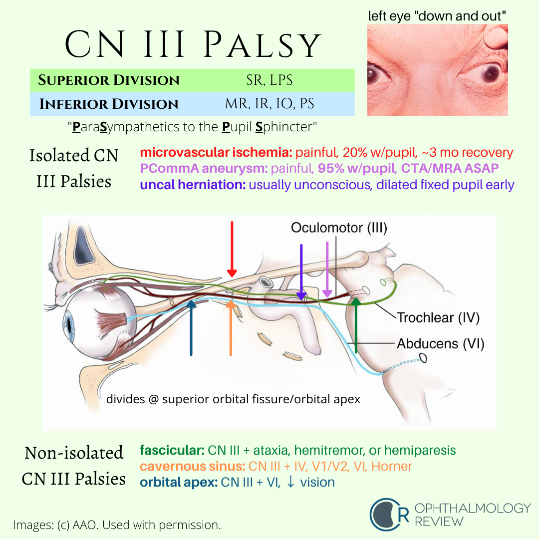 Cranial Nerve 3 Palsy: Multiple Cranial Nerve Palsies – UIEB