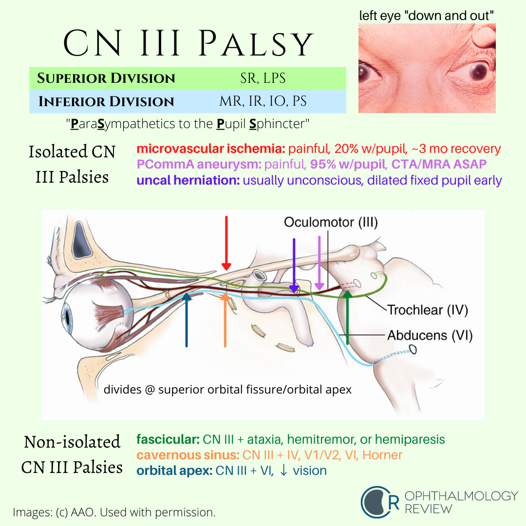 case study of 3rd nerve palsy