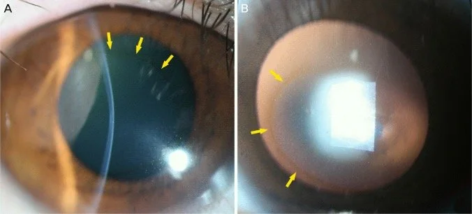 Corneal Iron Lines