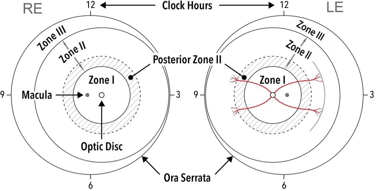 Retinopathy of Prematurity (Coffee Table Book) — Ophthalmology Review