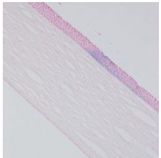 Corneal Iron Lines — Ophthalmology Review