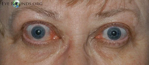 Thyroid Eye Disease