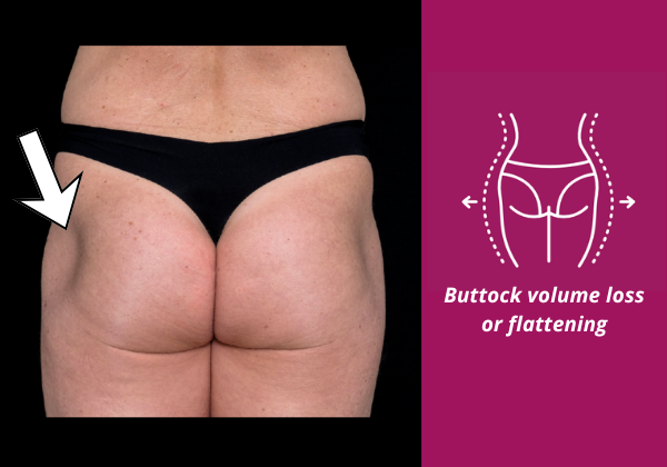Image showing flattened buttocks due to volume loss and how Sculptra butt lift can help with gradual buttock restoration through collagen stimulation