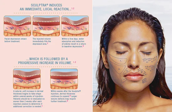 Sculptra Filler
