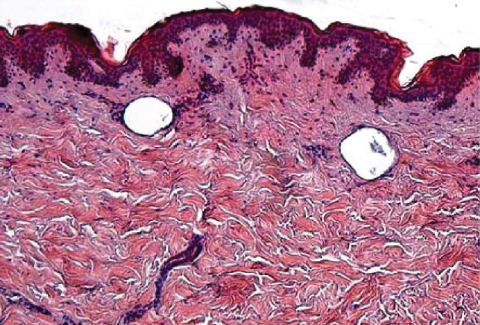 H&E stain section of skin tissue showing 0.2mm diameter vacuoles in the upper dermis caused by laser-induced optical breakdown. The tissue section was taken immediately after laser irradiation. Photo courtesy of Lutronic.