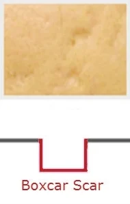 Acne-Scars-performanceskin.jpg