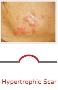 Acne-Scars-performanceskin.jpg