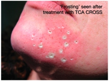 TCA CROSS Improves Atrophic Icepick Acne Scars [Update] — The Aesthetic  Studio Singapore Clinic & Surgery