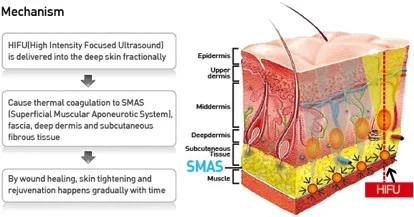 Doublo HIFU targets the deep SMAS layers of the face for lifting and tightening.