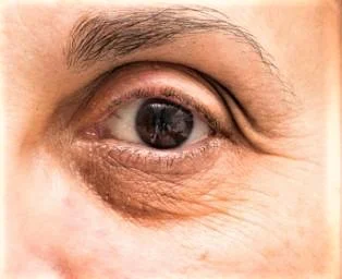 dark-eye circles treatment.jpg
