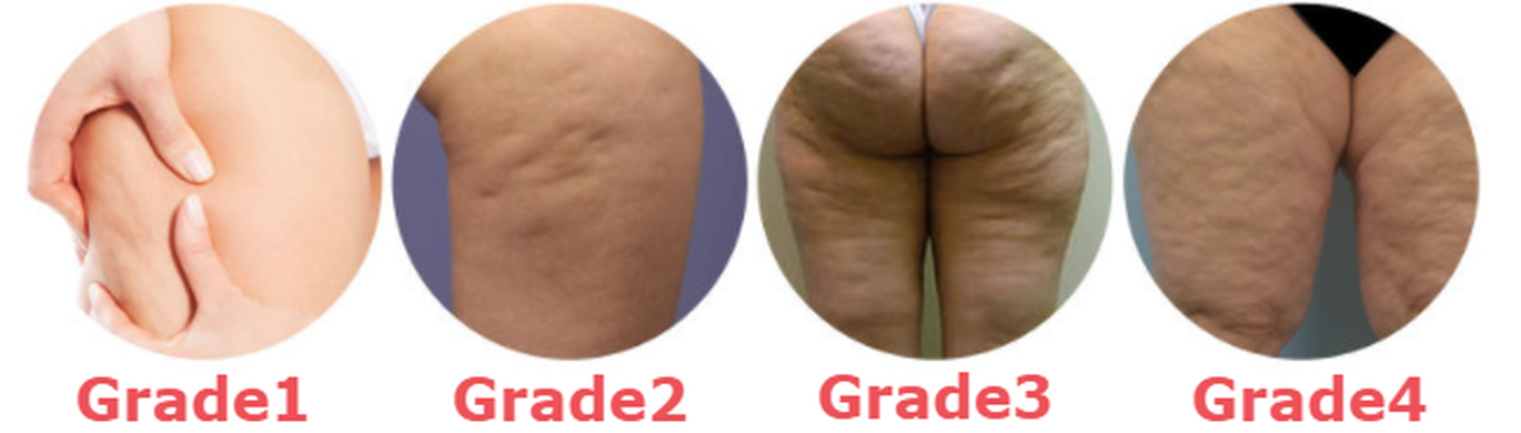 different grades of cellulite.png