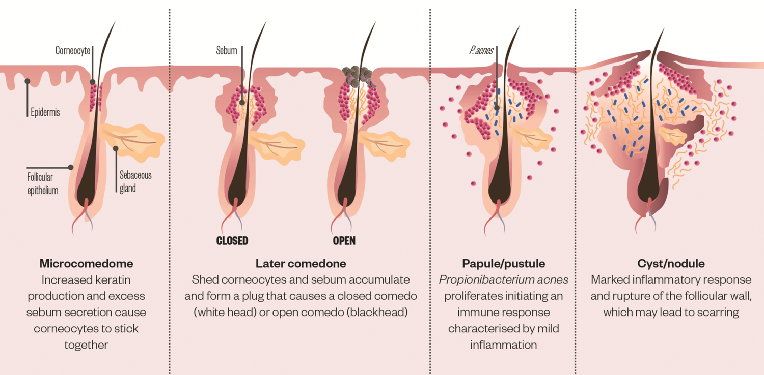 acne-pathogenesis-17.png