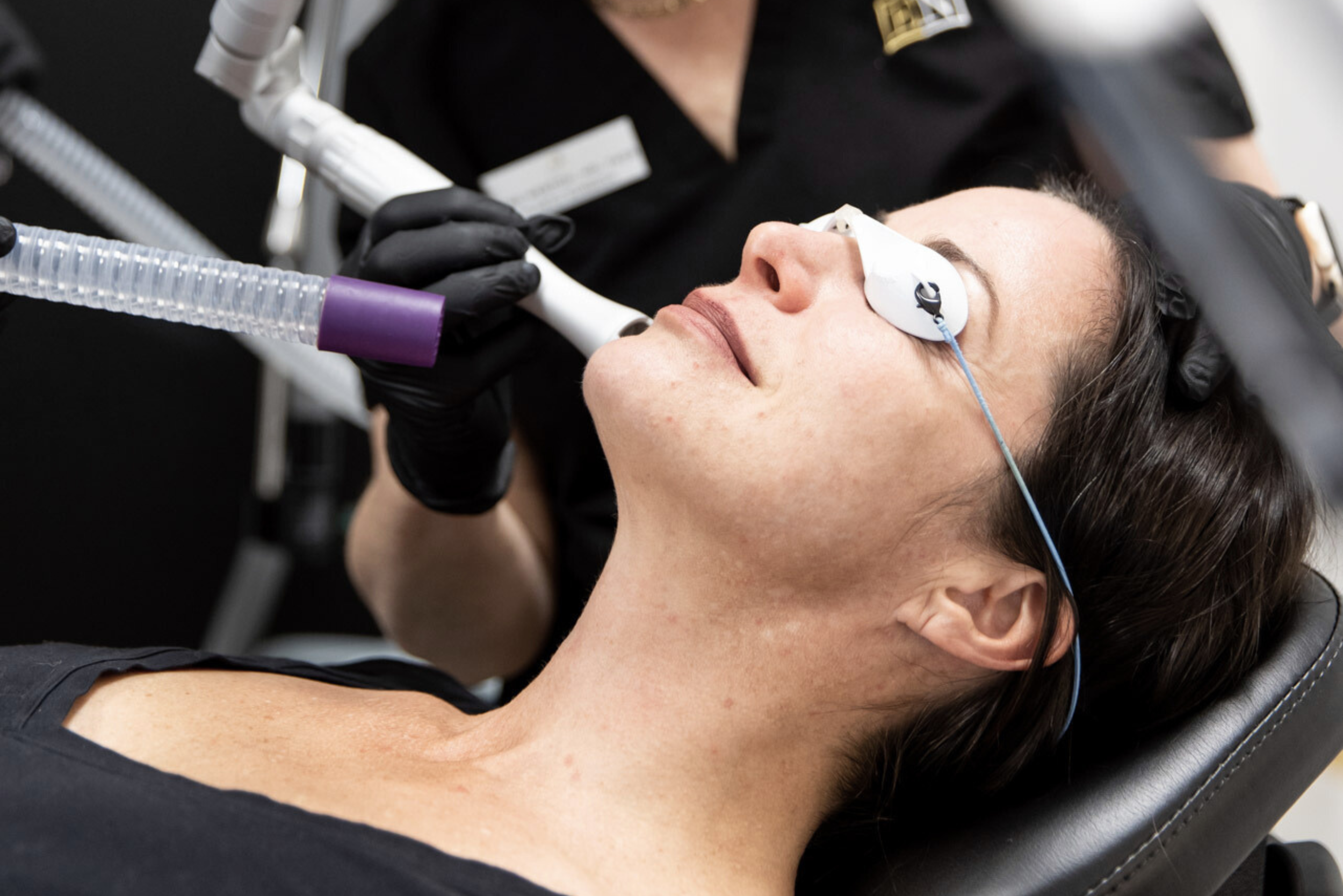Fractional CO2 Laser Resurfacing - Acne Scar Treatment & Skin Rejuvenation