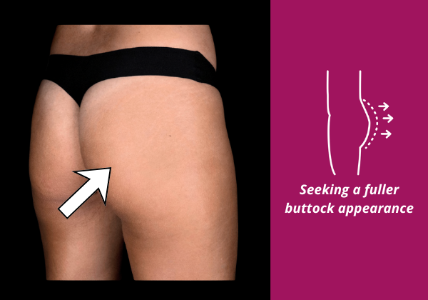 Image showing a flattened or less rounded buttock and how Sculptra butt lift can enhance shape as a non-surgical alternative