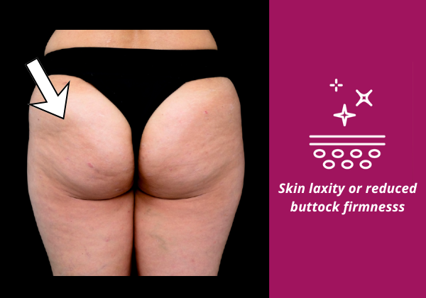 Image showing buttock skin laxity and reduced firmness, and how Sculptra butt lift can restore skin structure and firmness