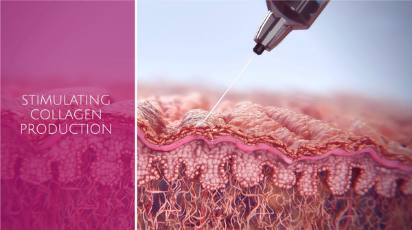Illustration showing how Sculptra’s poly-L-lactic acid (PLLA) particles stimulate the skin’s natural collagen production after injection