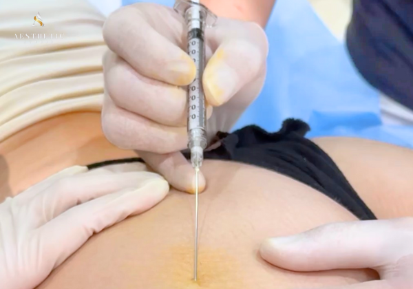 Butt fillers used for non-surgical butt enhancement to refine shape and improve overall buttock proportions