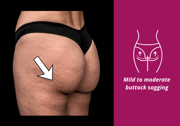 Image showing mild buttock sagging and how Sculptra butt lift injections improve firmness and lift by strengthening tissue structure