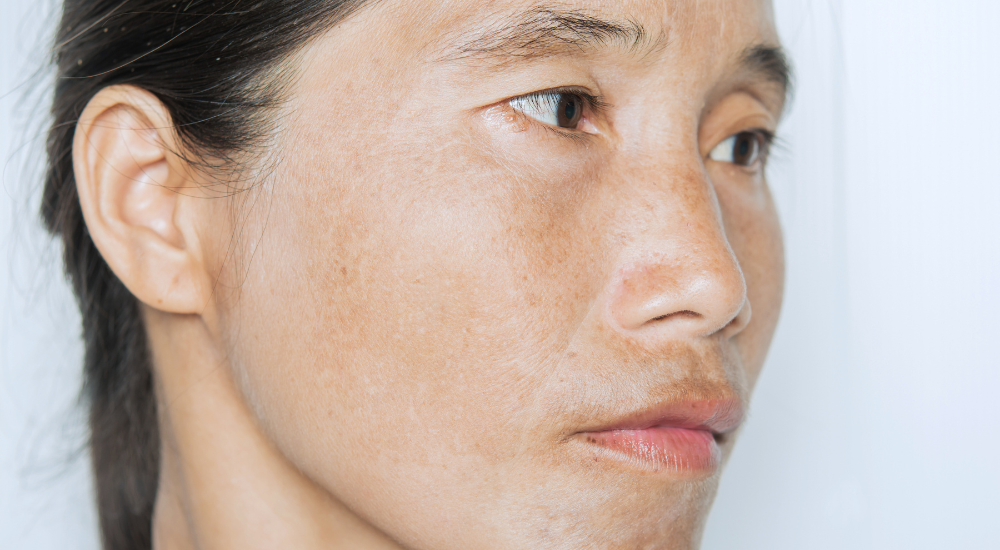Woman with visible melasma patches on the cheeks and forehead, illustrating deeper facial pigmentation caused by UV exposure and hormonal triggers