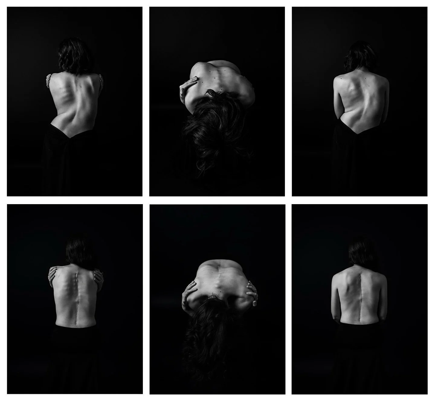 Last year, I had the privilege of photographing an incredible young lady with severe scoliosis. Her strength and grace were truly inspiring. A month ago, she returned to me, post-corrective surgery (spinal fusion), to capture the next chapter of her 