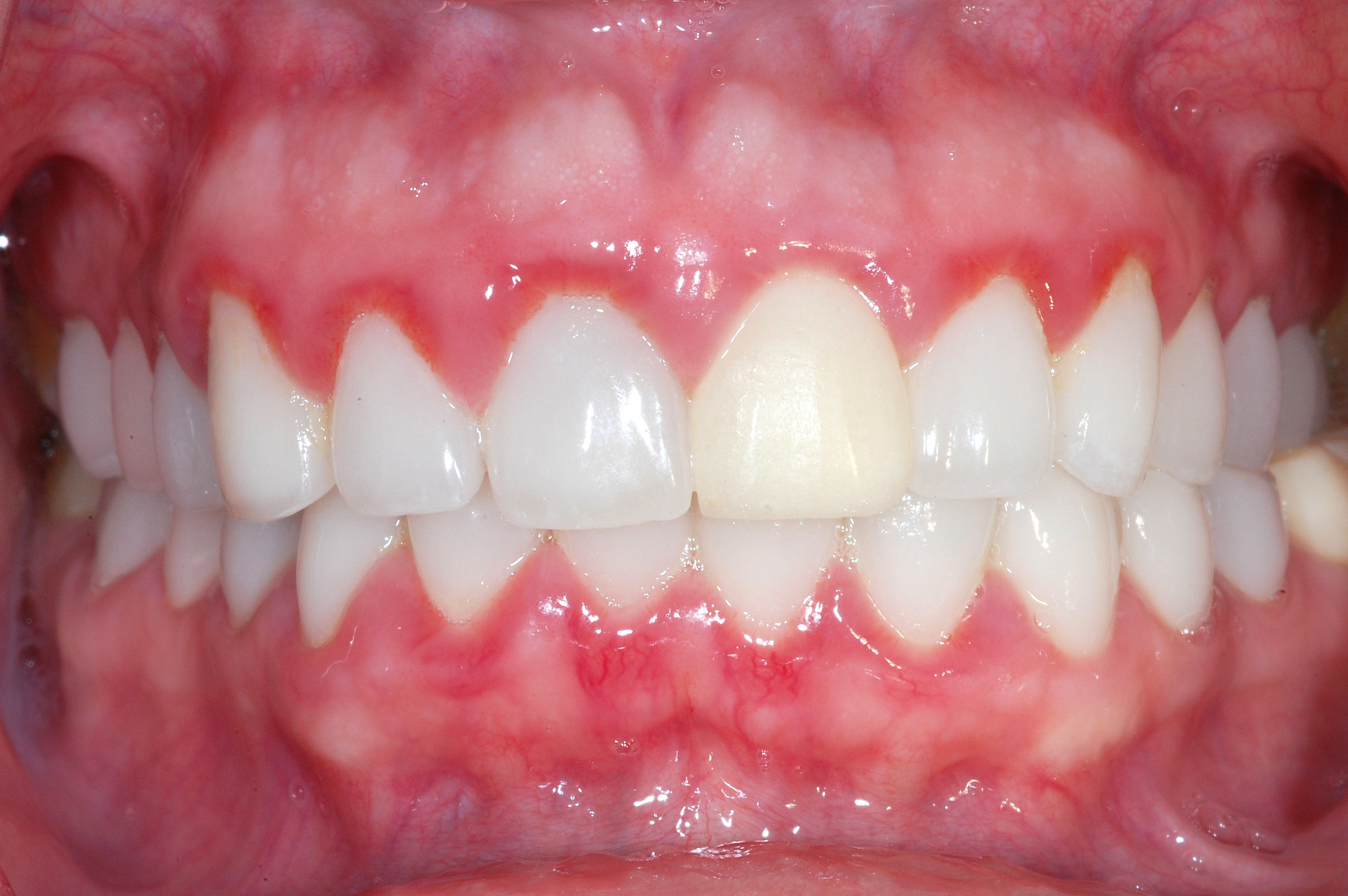 Gingivitis gums