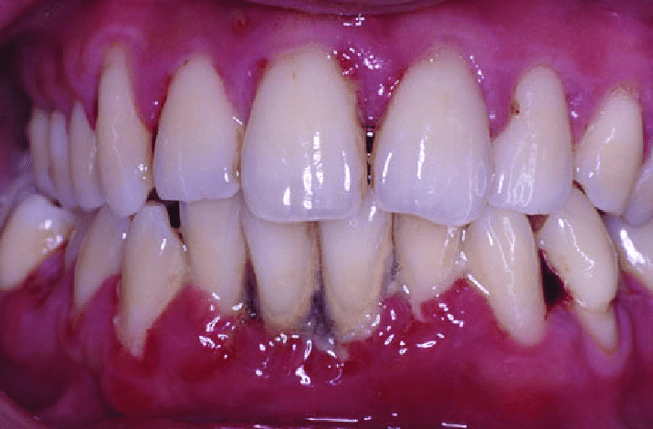 Severe Periodontitis