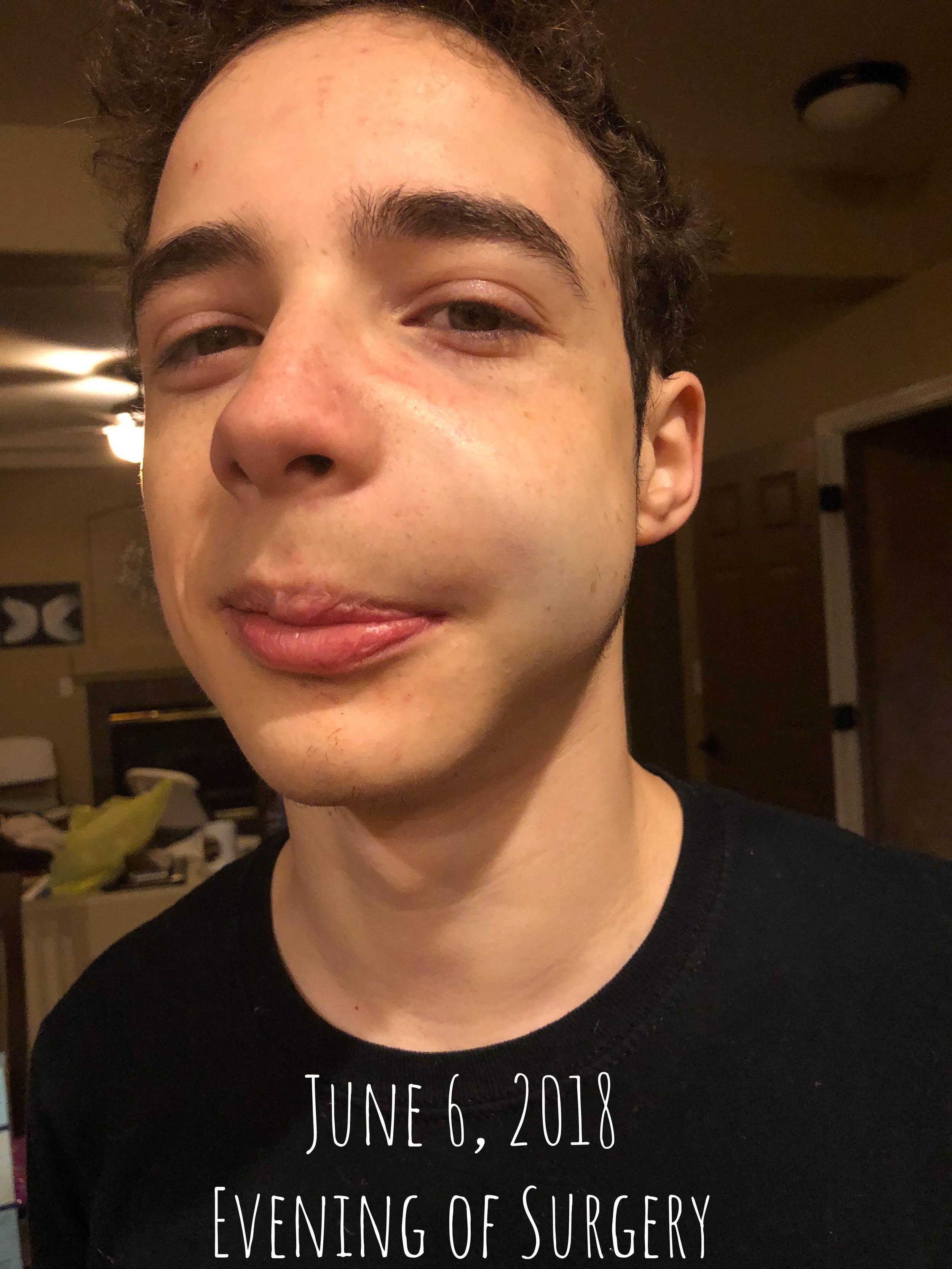 Parker after oral surgery to remove a cyst - June 6th, 2018