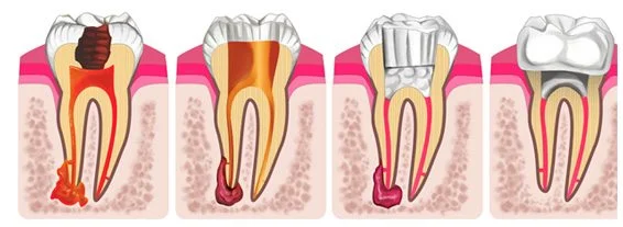 root-canals-1.jpg