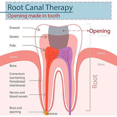 root-canal.jpg