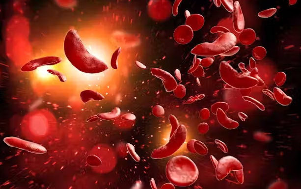 Academic Half Day: Sickle Cell Disease