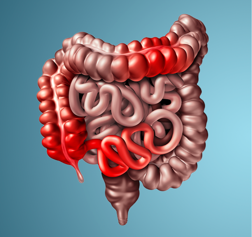 Academic Half Day: IBD