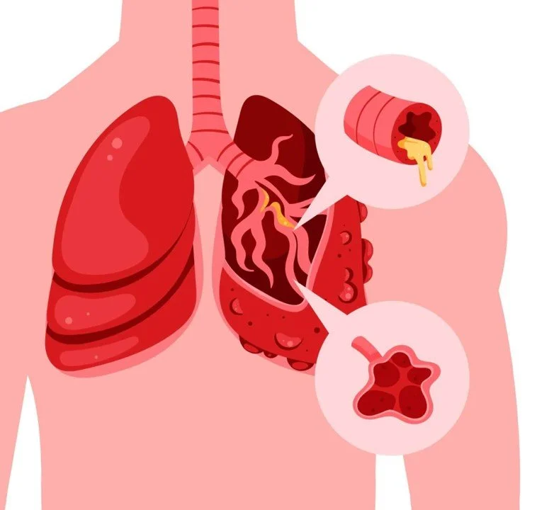 Academic Half Day: COPD