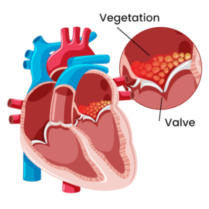 Academic Half Day: Endocarditis