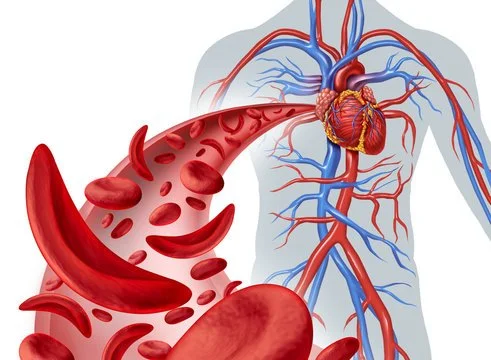 Academic Half Day: Sickle Cell Disease